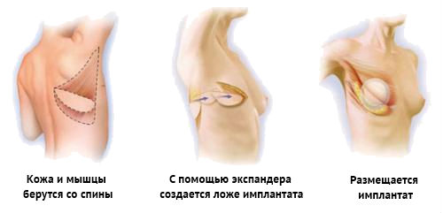 Quant costa la cirurgia d’augment de bust?